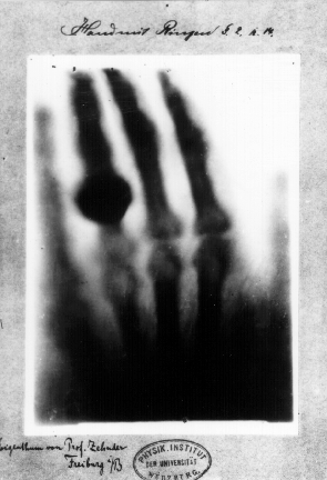 First medical X-ray by Wilhelm Röntgen of his wife Anna Bertha Ludwig's hand​​​